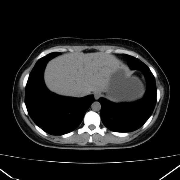 File:Ampullary tumor (Radiopaedia 22787-22816 Axial non-contrast 6).jpg