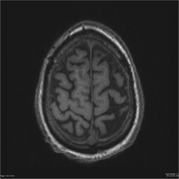 File:Anaplastic meningioma with recurrence (Radiopaedia 34452-35788 Axial T1 123).jpg