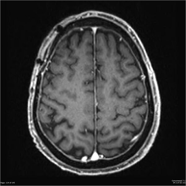 File:Anaplastic meningioma with recurrence (Radiopaedia 34452-35788 Axial T1 C+ 114).jpg