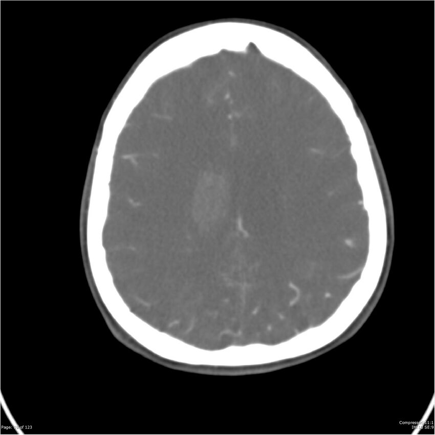 Aneurysmal subarachnoid hemorrhage and Moya Moya disease (Radiopaedia 34306-35593 Axial CT COW 18).jpg
