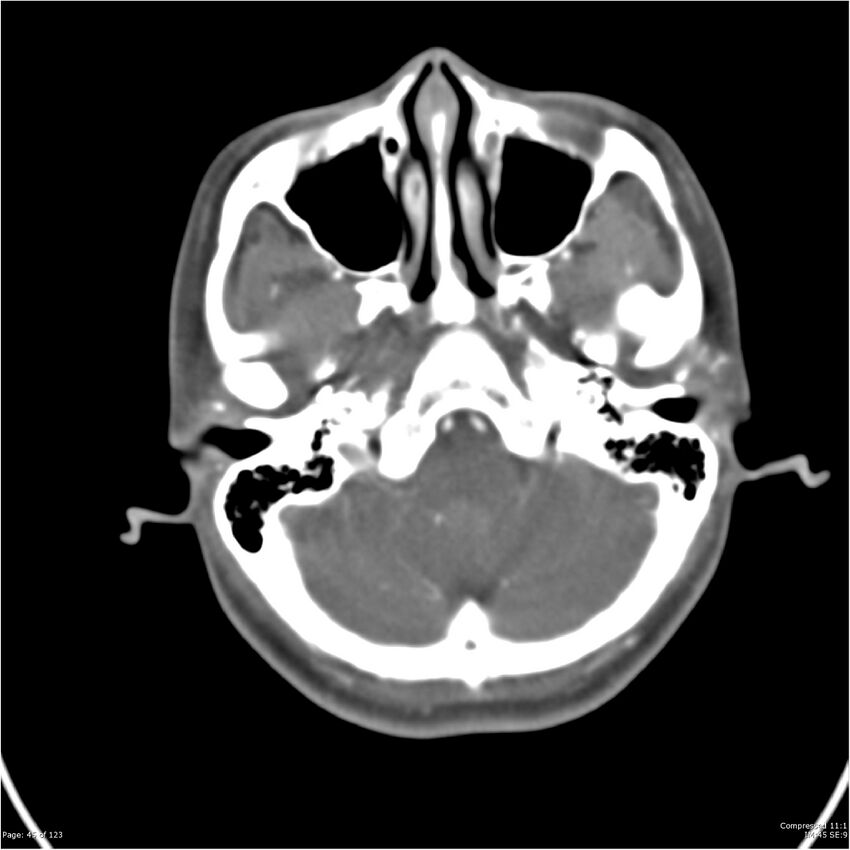 Aneurysmal subarachnoid hemorrhage and Moya Moya disease (Radiopaedia 34306-35593 Axial CT COW 45).jpg