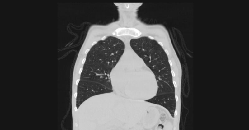 File:Angioinvasive aspergellosis (Radiopaedia 66995-76315 Coronal lung window 20).jpg