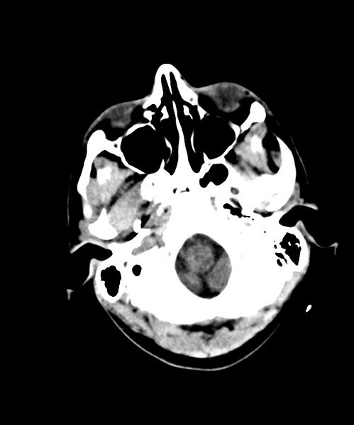 File:Angiomatous meningioma (Radiopaedia 79459-92578 Axial non-contrast 5).jpg