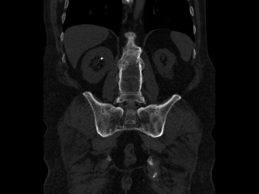 Ankylosing spondylitis (Radiopaedia 44609-48357 Coronal bone window 63).jpg