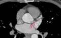 Anomalous coronary arteries (Radiopaedia 83979-99207 CT axial 1).jpg