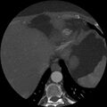 Anomalous origin of left circumflex artery from right coronary sinus (Radiopaedia 72563-83117 A 3).jpg