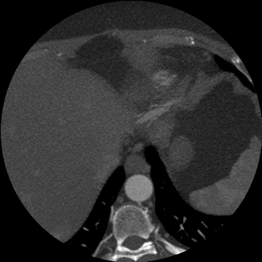 Anomalous origin of left circumflex artery from right coronary sinus (Radiopaedia 72563-83117 A 3).jpg