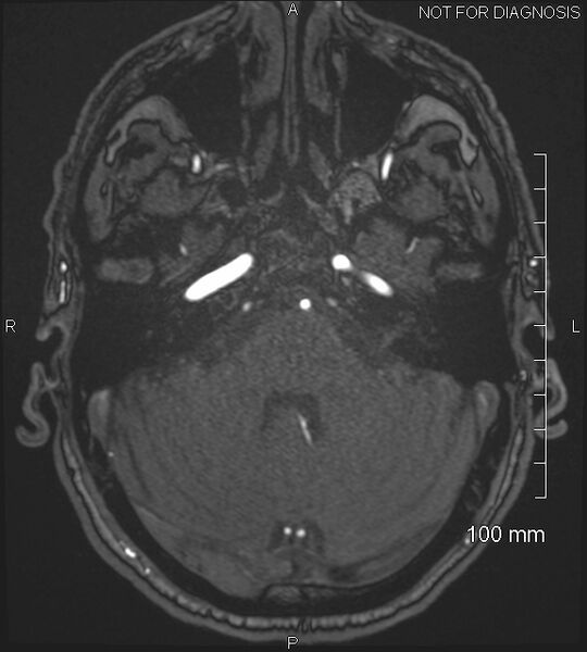 File:Anterior cerebral artery aneurysm (Radiopaedia 80683-94127 Axial MRA 53).jpg