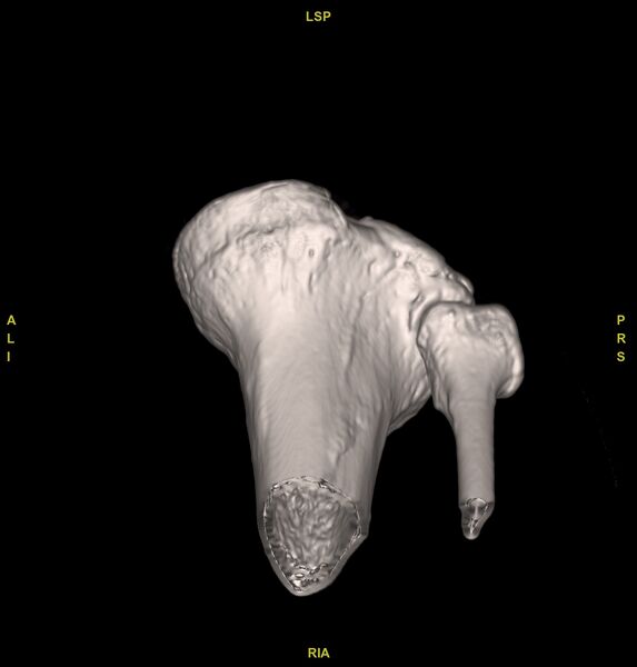 File:Anterior cruciate ligament avulsion fracture (Radiopaedia 58939-66194 VRT 15).jpg