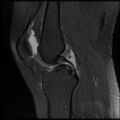 Anterior cruciate ligament tear, Wrisberg rip and bucket-handle tear of medial meniscus (Radiopaedia 75872-87266 Sagittal PD fat sat 15).jpg