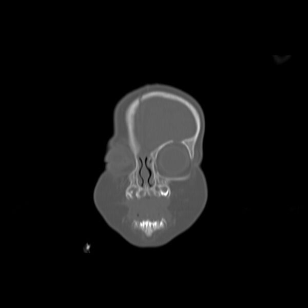 File:Anterior plagiocephaly (Radiopaedia 71836-82273 Coronal bone window 18).jpg