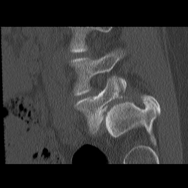 File:Anterolisthesis (Radiopaedia 22226-22263 Sagittal bone window 4).jpg
