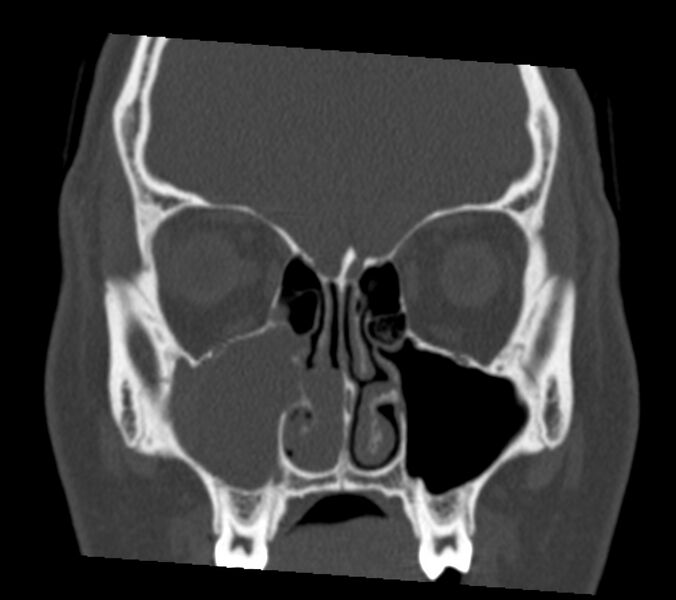File:Antrochoanal polyp (Radiopaedia 21894-21868 Coronal bone window 13).jpg
