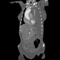 Aortic dissection (Radiopaedia 68763-78691 B 7).jpeg