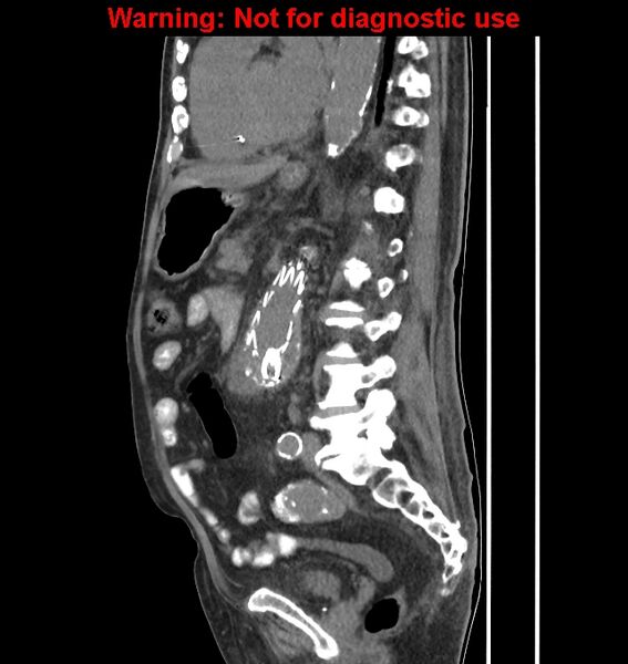 File:Aortic graft infection (Radiopaedia 44979-48907 C 29).jpg