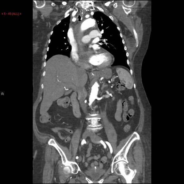 File:Aortic intramural hematoma (Radiopaedia 27746-28001 B 26).jpg