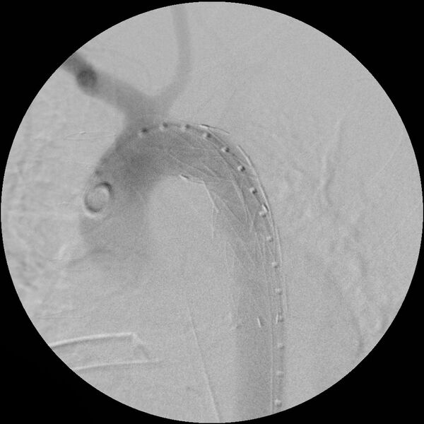 File:Aortic transection and subclavian steal (Radiopaedia 8711-9517 Stent 5).jpg