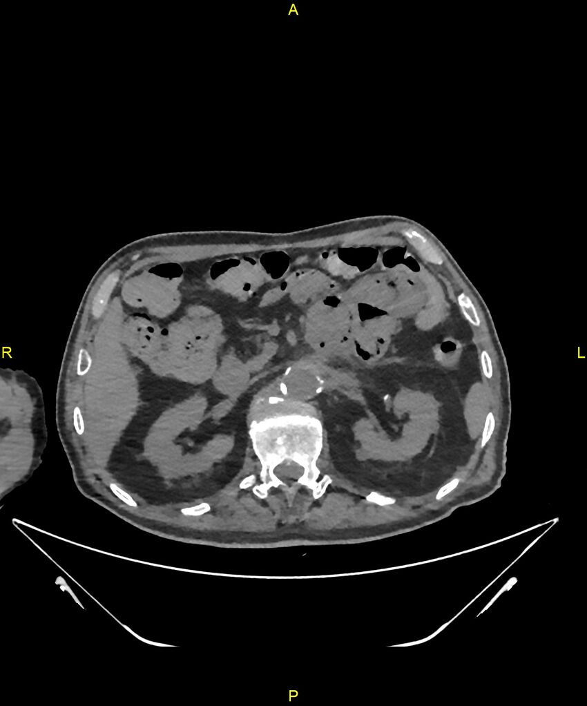 Aortoenteric fistula (Radiopaedia 84308-99603 Axial non-contrast 108).jpg