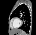 Aortopulmonary window, interrupted aortic arch and large PDA giving the descending aorta (Radiopaedia 35573-37074 C 41).jpg