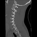 Apical pneumothorax on cervical spine CT (Radiopaedia 45343-49368 Sagittal bone window 24).jpg