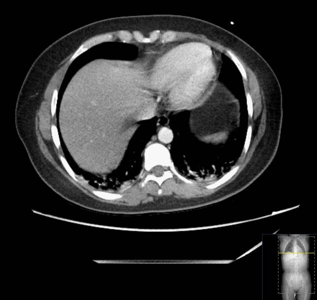 File:Appendicitis (CT angiogram) (Radiopaedia 154713-127660 Axial 176).jpg