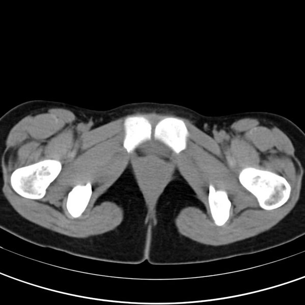 File:Appendicitis and incidental bicornuate uterus (Radiopaedia 22833-22853 Axial non-contrast 48).jpg