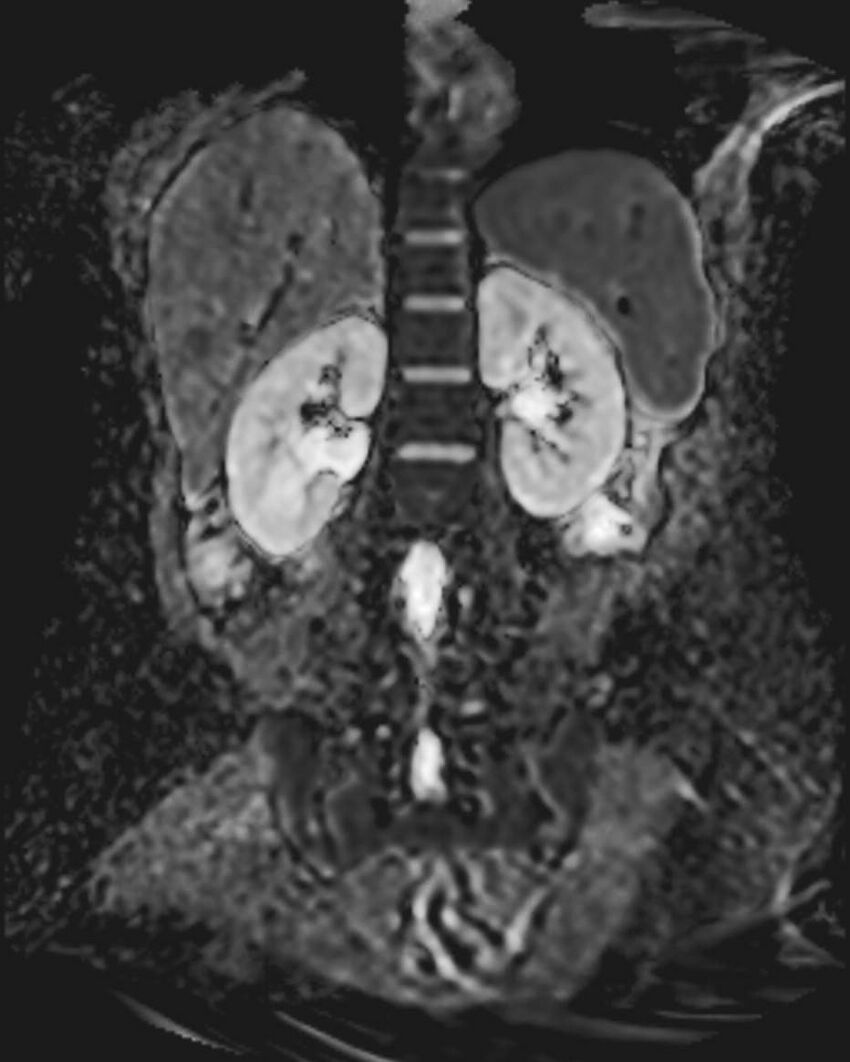 Appendicitis in gravida (MRI) (Radiopaedia 89433-106395 Coronal ADC 41).jpg