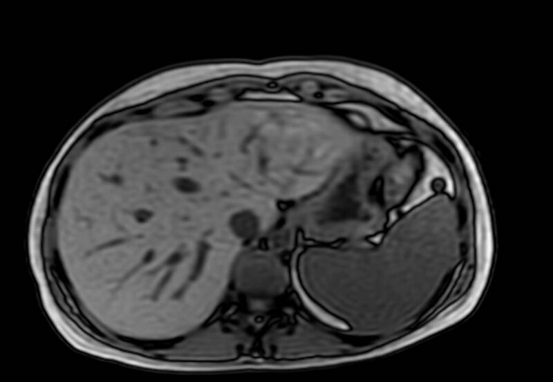 File:Appendicitis in gravida (MRI) (Radiopaedia 89433-106395 D 8).jpg