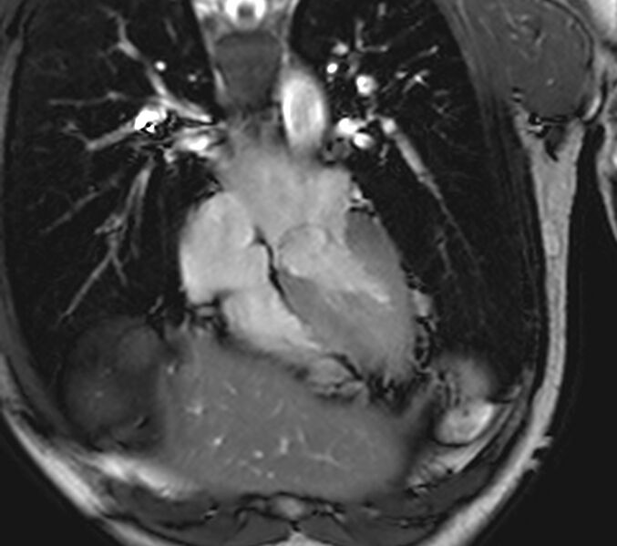 File:Arrhythmogenic right ventricular cardiomyopathy (Radiopaedia 39806-42237 D 116).jpg