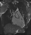 Arrhythmogenic right ventricular cardiomyopathy (Radiopaedia 57972-64966 CINE R2 SSFP 43).jpg