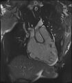 Arrhythmogenic right ventricular cardiomyopathy (Radiopaedia 57972-64966 CINE R2 SSFP 44).jpg