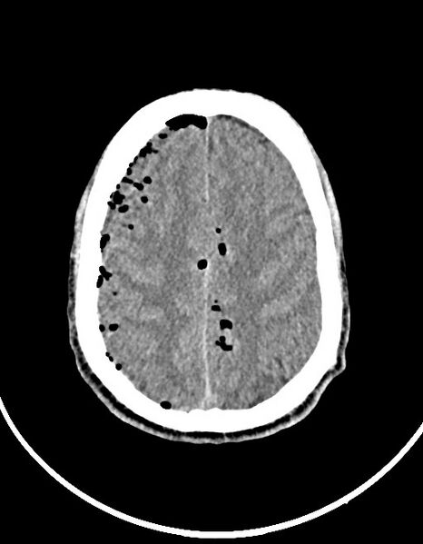File:Arrow injury to the brain (Radiopaedia 72101-82607 Axial 71).jpg