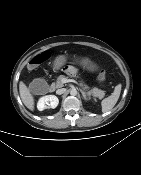 File:Arterial occlusive mesenteric ischemia (Radiopaedia 84641-100054 A 41).jpg
