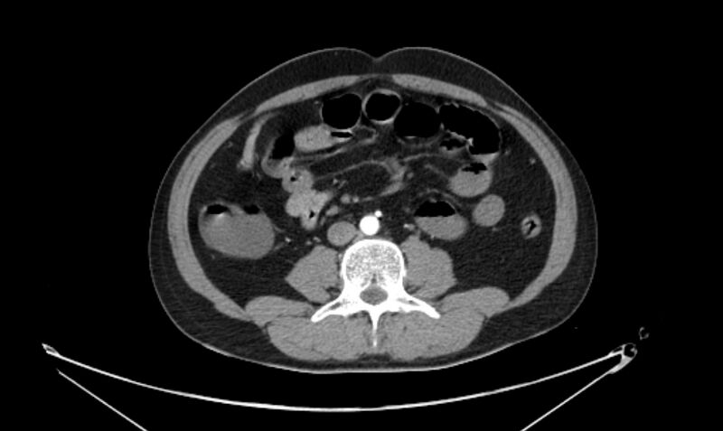 File:Arterial occlusive mesenteric ischemia (Radiopaedia 84641-100060 A 73).jpg
