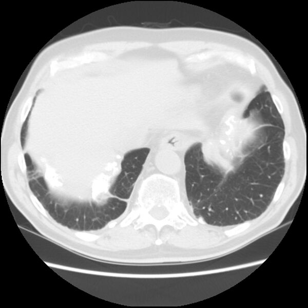File:Asbestos-related pleural plaques (Radiopaedia 39069-41255 Axial lung window 60).jpg
