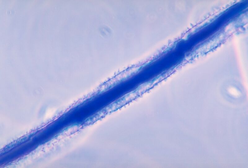 File:Aspergillus flavus (microscopy) (Radiopaedia 13555).jpg