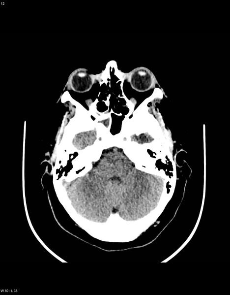 File:Astroblastoma (Radiopaedia 39792-42216 Axial non-contrast 11).jpg