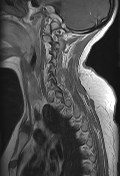 File:Astrocytoma - spinal cord (Radiopaedia 69769-79758 Sagittal T1 C+ 3).jpg