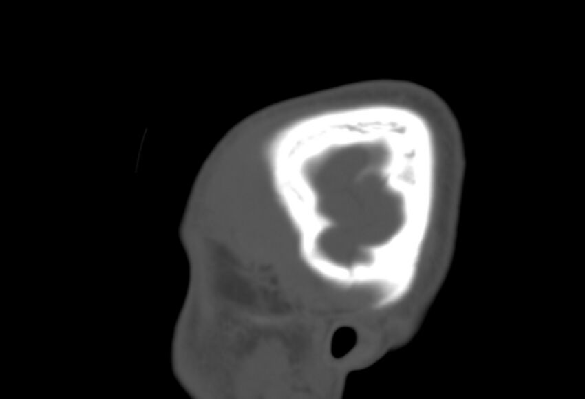 Asymptomatic occipital spur (Radiopaedia 87753-104201 Sagittal bone window 7).jpg