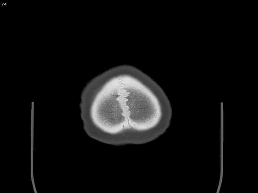 Atypical meningioma - intraosseous (Radiopaedia 64915-73867 Axial C+ bone window 74).jpg