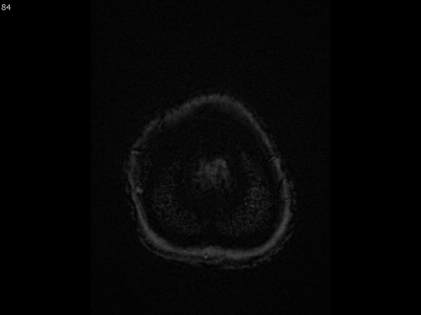 Atypical meningioma - intraosseous (Radiopaedia 64915-74572 Axial SWI 84).jpg