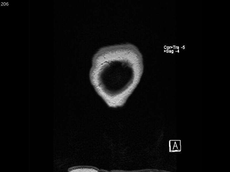 File:Atypical meningioma - intraosseous (Radiopaedia 64915-74572 Coronal T1 206).jpg