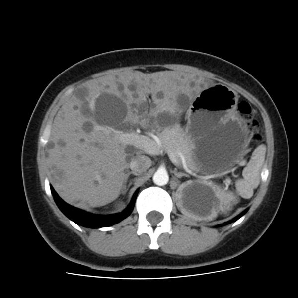 File:Autosomal dominant polycystic kidney disease (Radiopaedia 23061-23093 B 20).jpg