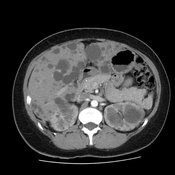 File:Autosomal dominant polycystic kidney disease (Radiopaedia 23061-23093 B 23).jpg