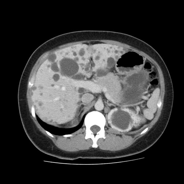 File:Autosomal dominant polycystic kidney disease (Radiopaedia 23061-23093 C 19).jpg