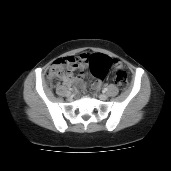 File:Autosomal dominant polycystic kidney disease (Radiopaedia 23061-23093 C 53).jpg