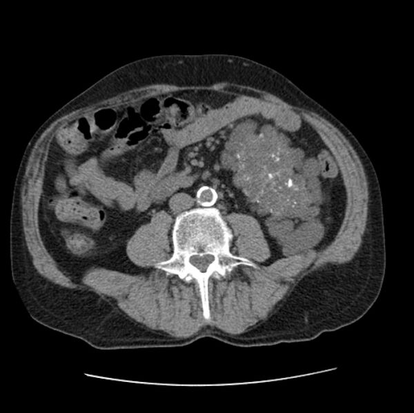 File:Autosomal dominant polycystic kidney disease (Radiopaedia 27851-28094 Axial non-contrast 80).jpg