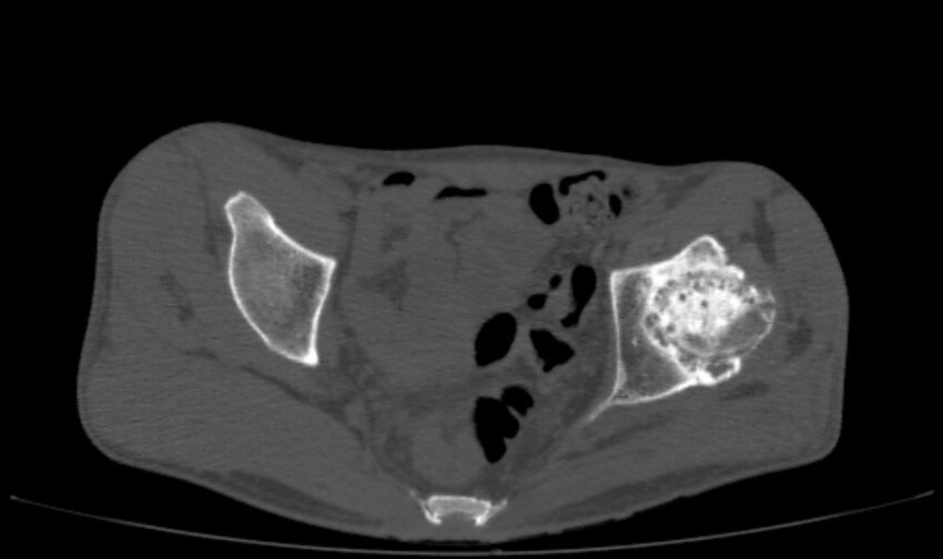 Avascular necrosis of the left hip (Radiopaedia 75068-86125 Axial bone window 24).jpg