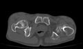 Avascular necrosis of the left hip (Radiopaedia 75068-86125 Axial bone window 77).jpg