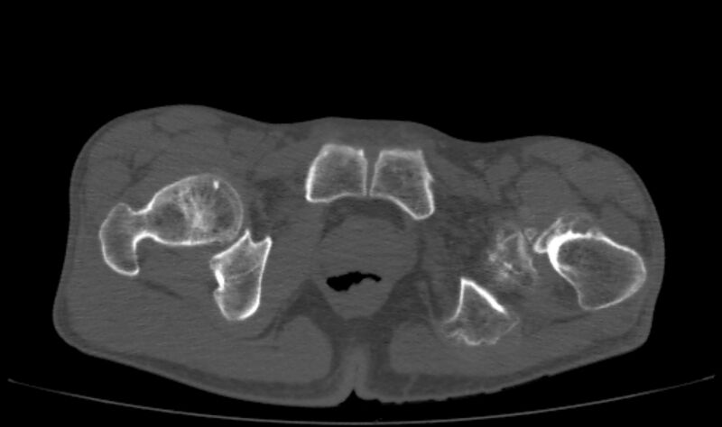 File:Avascular necrosis of the left hip (Radiopaedia 75068-86125 Axial bone window 77).jpg